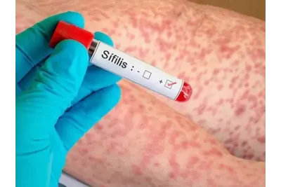 Máxima alerta en Mar del Plata por el avance de la sífilis: casos récord y preocupación por el aumento de los contagios