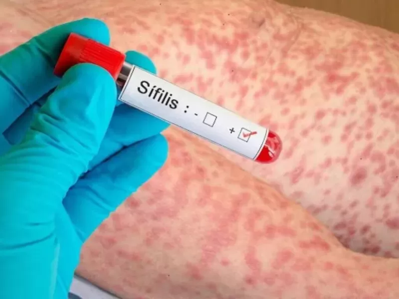 M&aacute;xima alerta en Mar del Plata por el avance de la s&iacute;filis: casos r&eacute;cord y preocupaci&oacute;n por el aumento de los contagios